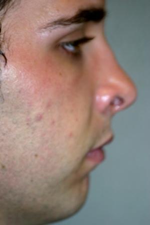 Chin Implant