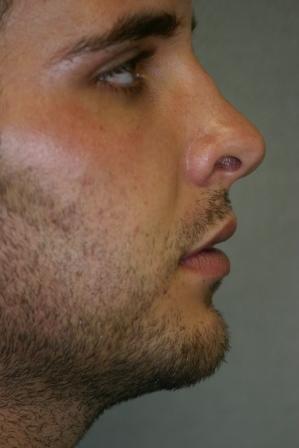 Chin Implant