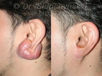 Keloid Removal