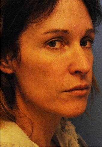 Fat Transfer to Face