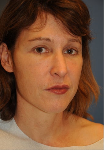 Fat Transfer to Face