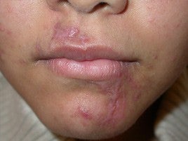 Scar Treatment