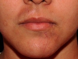 Scar Treatment
