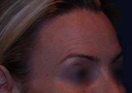 Botox