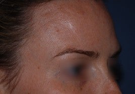 Botox