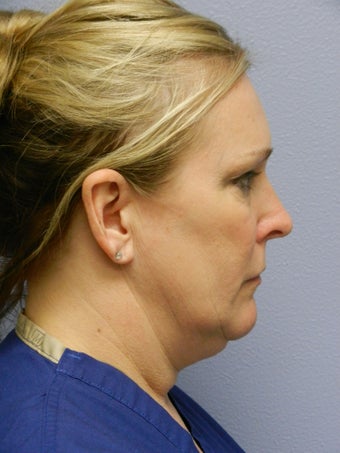 Laser Liposuction 