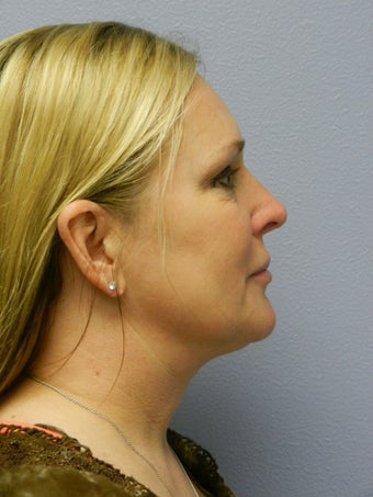 Laser Liposuction 