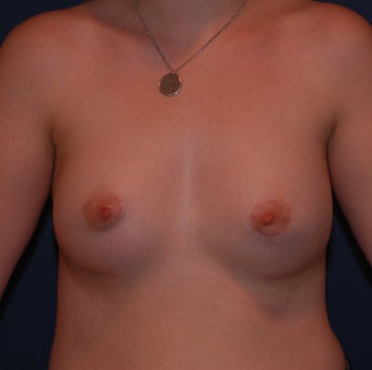 Reconstruction of Tubular Breast Deformity