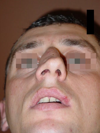 Crooked nose correction