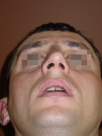 Crooked nose correction