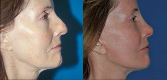 Facelift, rhinoplasty, endo forehead lift, fat injection, laser