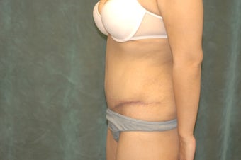 Women's Tummy Tuck Revision 