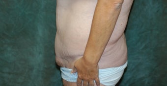 Women's Tummy Tuck Revision 