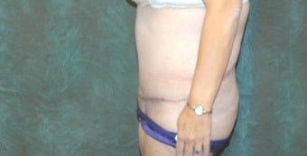Women's Tummy Tuck Revision 