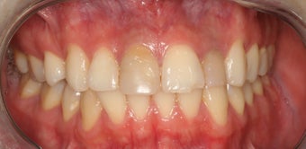 Anterior all ceramic crowns