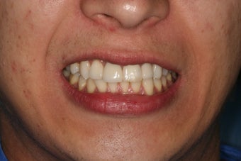 Anterior all ceramic crowns