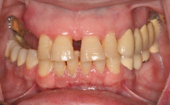 Full Mouth reconstruction, Smile makeover