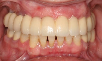 Full Mouth reconstruction, Smile makeover