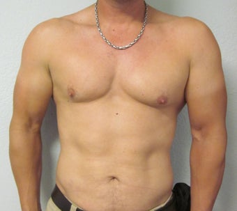 Liposuction 