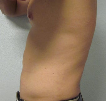 Liposuction 