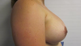 Mastopexy/ Breast Augmentation 
