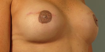Bilateral Tissue Expander Reconstruction Following Mastectomy