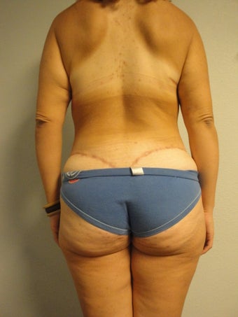 Body Lift 