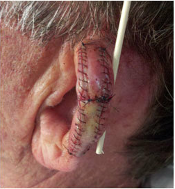 Skin Cancer Surgery on Ear