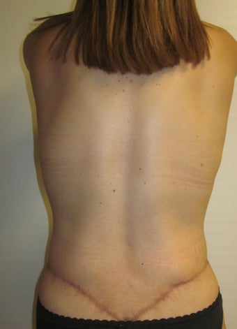 Body Lift 