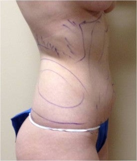 Laser Liposuction