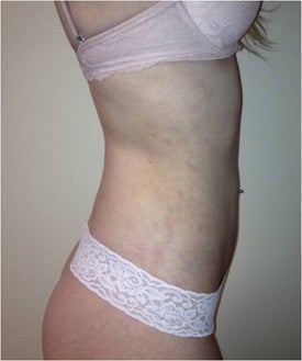 Laser Liposuction