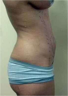 Laser Liposuction