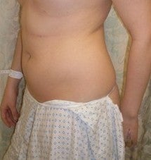 Laser Liposuction