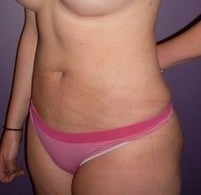 Laser Liposuction