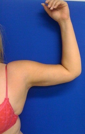 Laser Liposuction