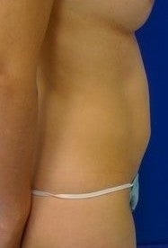 Laser Liposuction