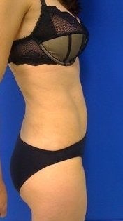 Laser Liposuction