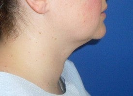 Laser Liposuction