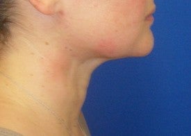 Laser Liposuction