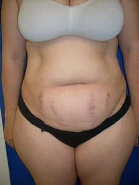 Laser Liposuction