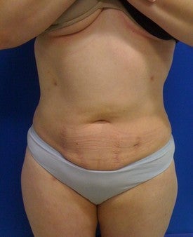 Laser Liposuction
