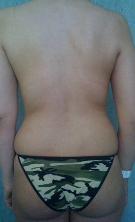Laser Liposuction