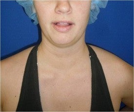 Laser Liposuction