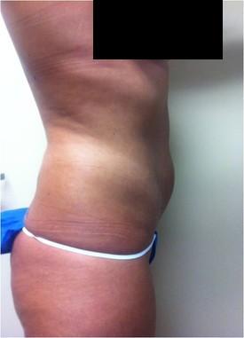 Laser Liposuction