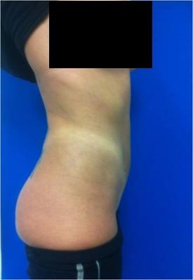 Laser Liposuction
