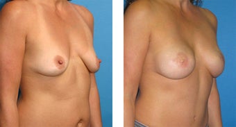 Breast Reconstruction: One-Stage Breast Reconstruction