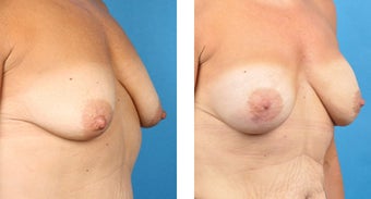 Breast Reconstruction: One-Stage Breast Reconstruction