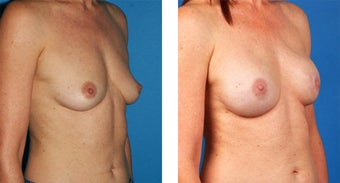 Breast Reconstruction: One-Stage Breast Reconstruction