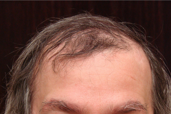 NeoGraft hair transplant