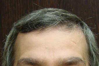 NeoGraft hair transplant
